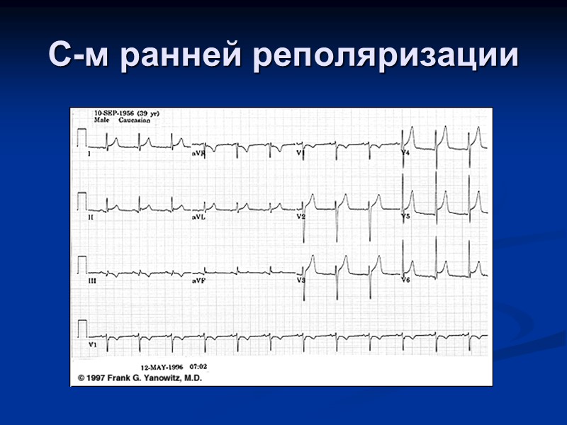С-м ранней реполяризации